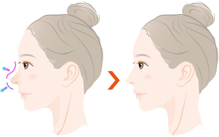 切らない鼻中隔延長とは、溶ける糸を使用し鼻を改善させる施術のことです