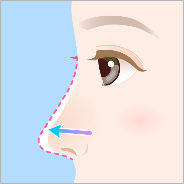 バレずに鼻の穴 小鼻を小さく小鼻縮小術 鼻翼縮小術 美容整形なら東京中央美容外科 Tcb公式