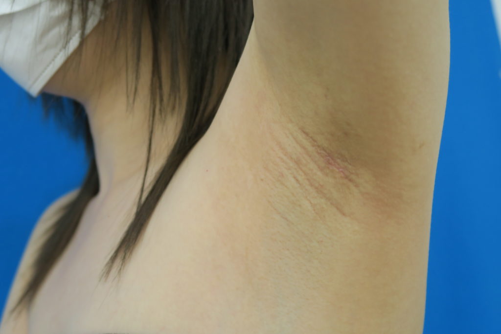 ワキガ手術跡画像: ワキガ 手術 しない 方がいい – MIZQL