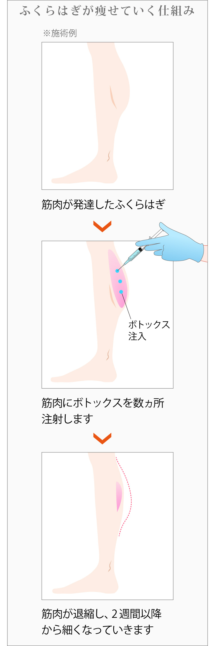 ふくらはぎ 太もも 二の腕を細くするならボトックス注射 美容整形なら東京中央美容外科 Tcb公式
