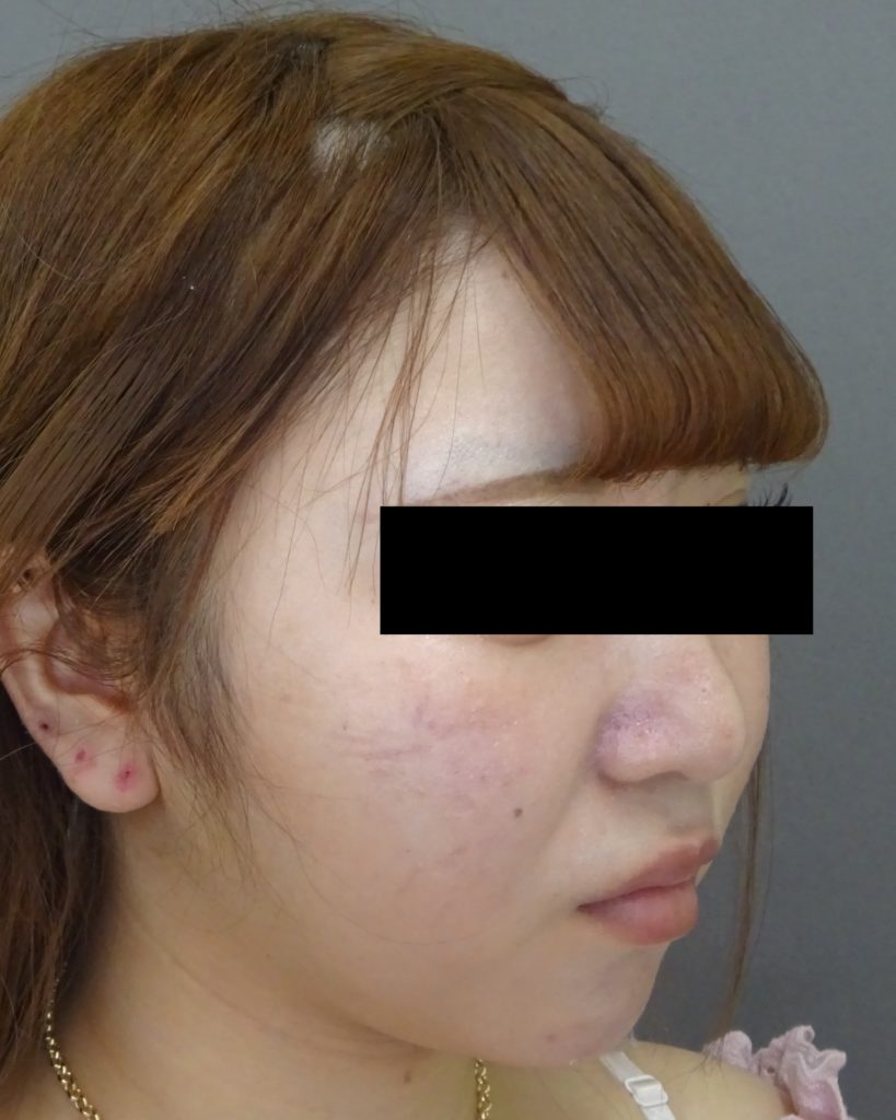 顔（頬・頬骨上・顎下）の脂肪吸引-症例写真-ビフォーアフター