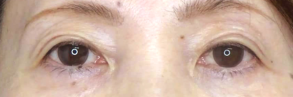 目の上のたるみ取り（上眼瞼除皺術）-症例写真-ビフォーアフター