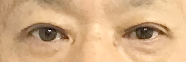 目の上のたるみ取り（上眼瞼除皺術）-症例写真-ビフォーアフター