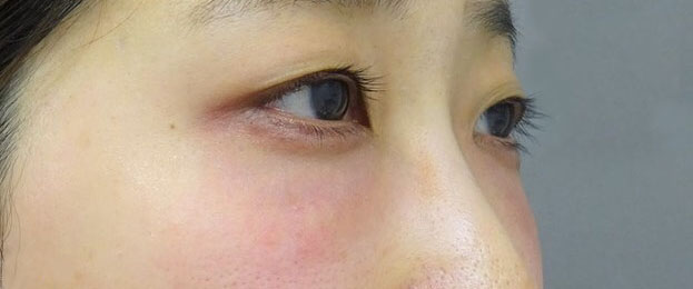 目の下のヒアルロン酸注射-症例写真-ビフォーアフター