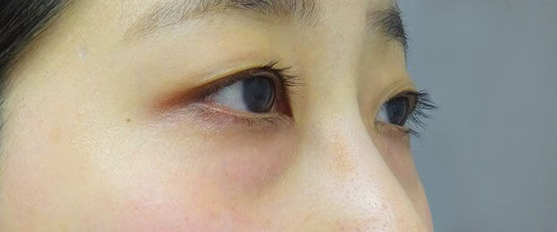 目の下のヒアルロン酸注射-症例写真-ビフォーアフター