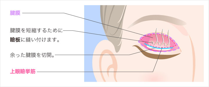 眼瞼下垂マッサージは効果的 正しい眼瞼下垂の改善法 自力での改善法と整形術での改善法 美容整形なら東京中央美容外科 Tcb公式