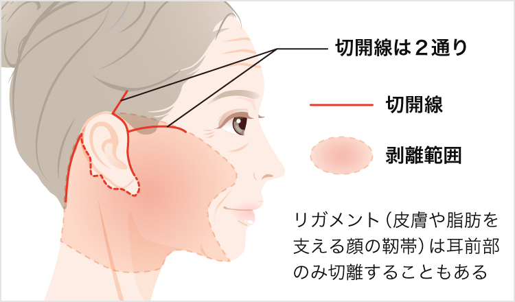 切るフェイスリフト整形 顔のリフトアップで頬のたるみを引き上げて解消 美容整形なら東京中央美容外科 Tcb公式