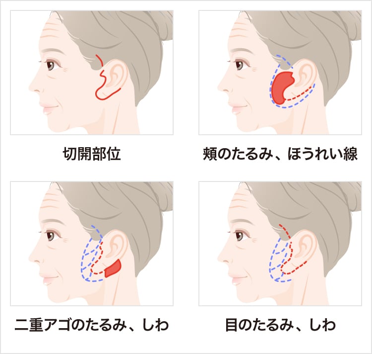 切るフェイスリフト整形 顔のリフトアップで頬のたるみを引き上げて解消 美容整形なら東京中央美容外科 Tcb公式