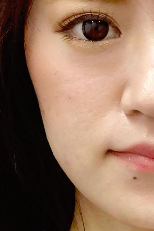 TCB式小顔美肌再生-症例写真-ビフォーアフター
