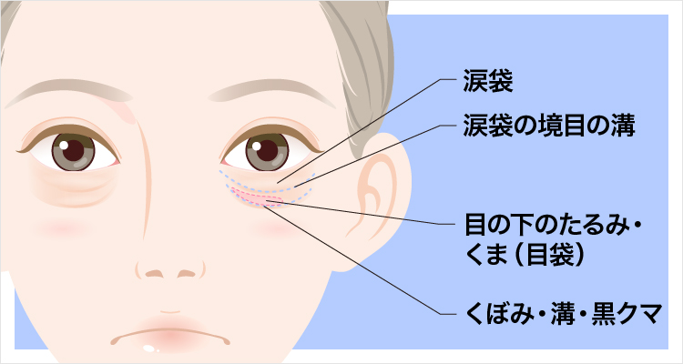 目の下のたるみがひどい原因 たるみ改善治療について 美容整形なら東京中央美容外科 Tcb公式