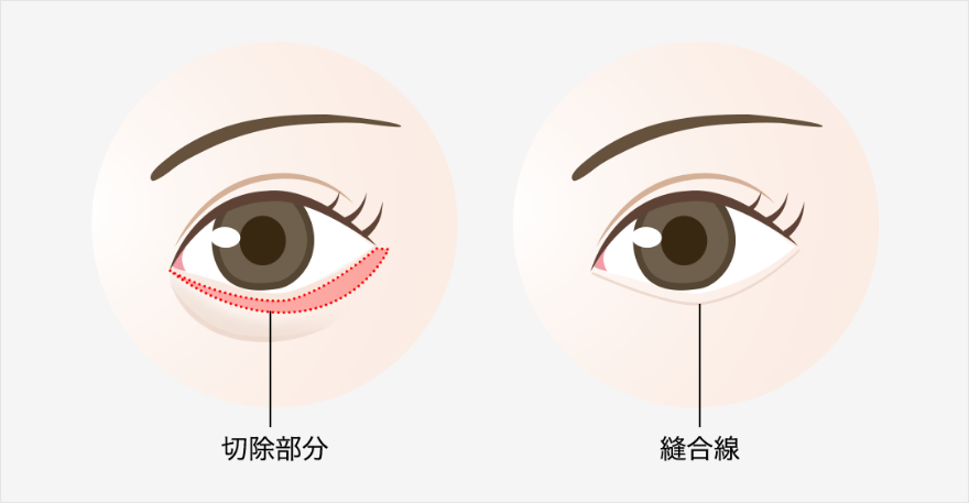 切開法による目の下のたるみ取り（下眼瞼除皺術）の手術方法