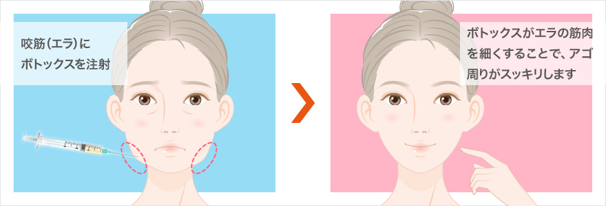 お顔の肉を落とす効果的な小顔治療方法とは 美容整形なら東京中央美容外科 Tcb公式