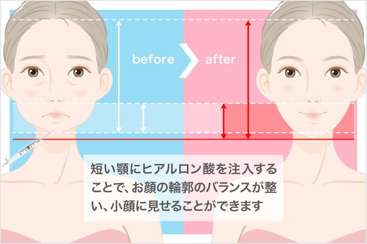 お顔の肉を落とす効果的な小顔治療方法とは 美容整形なら東京中央美容外科 Tcb公式