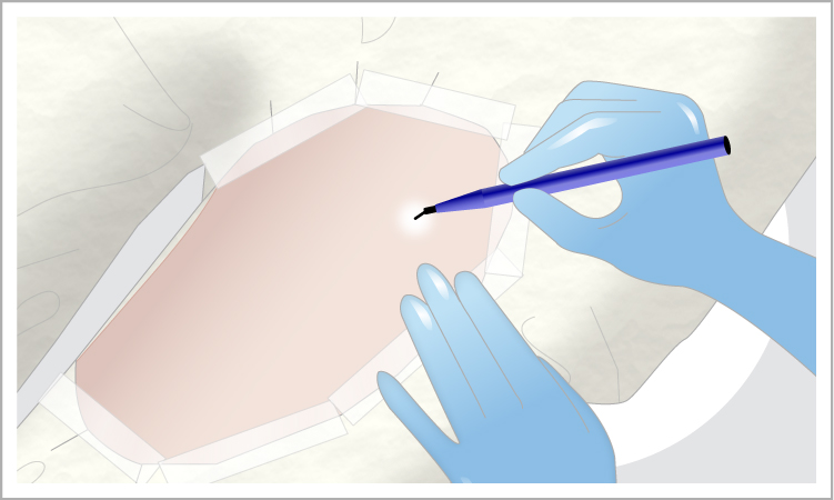 頬 目の下 ほうれい線への脂肪注入 コンデンスリッチを超える ナノファット 美容整形なら東京中央美容外科 Tcb公式