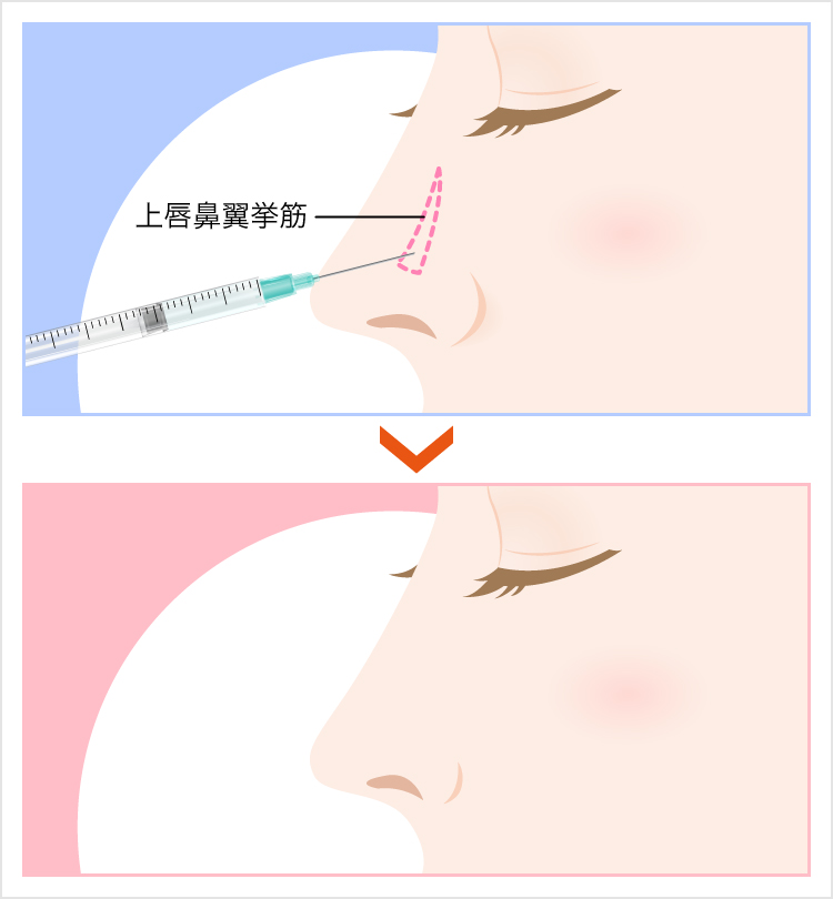 小鼻（鼻翼）の広がりを抑えたい