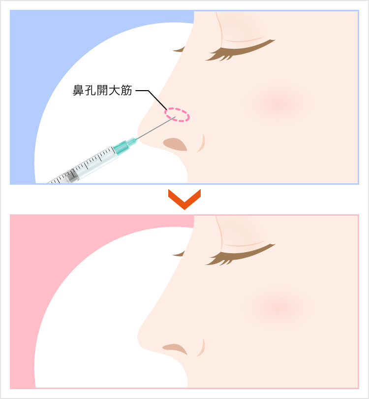 鼻の穴が大きくなるのを抑えたい