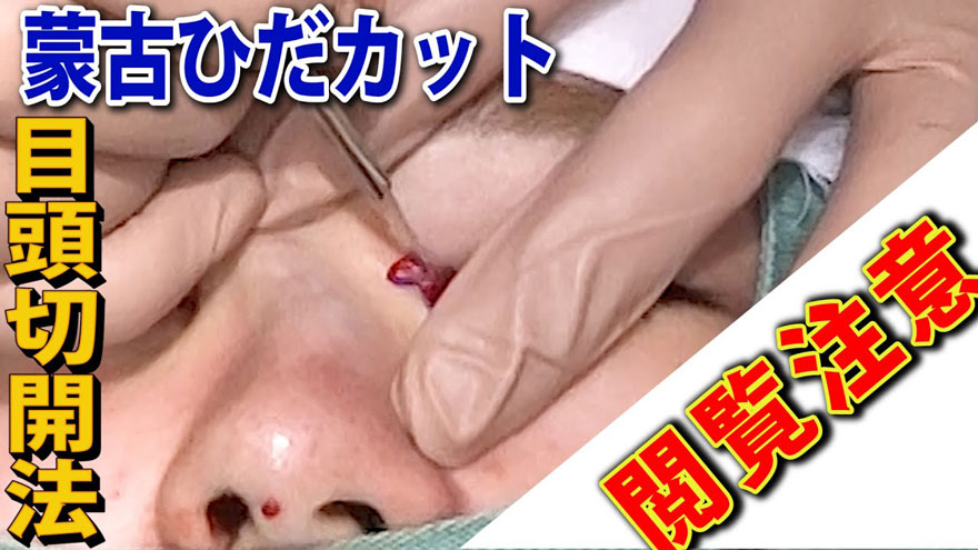 【さよなら蒙古ひだ】Z式目頭切開で平行型の二重に！？