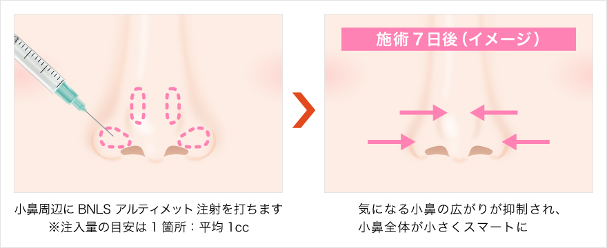 TCB東京中央美容外科 小鼻縮小脂肪溶解注射(BNLS アルティメット) 施術の特徴