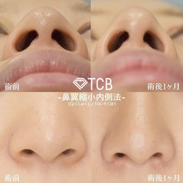 TCB式鼻翼縮小完全内側法症例写真ビフォーアフター02
