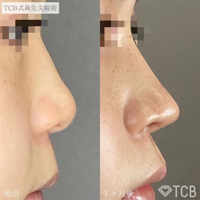 TCB式鼻先尖鋭術症例写真ビフォーアフター01