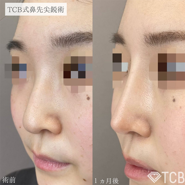 TCB式鼻先尖鋭術症例写真ビフォーアフター02