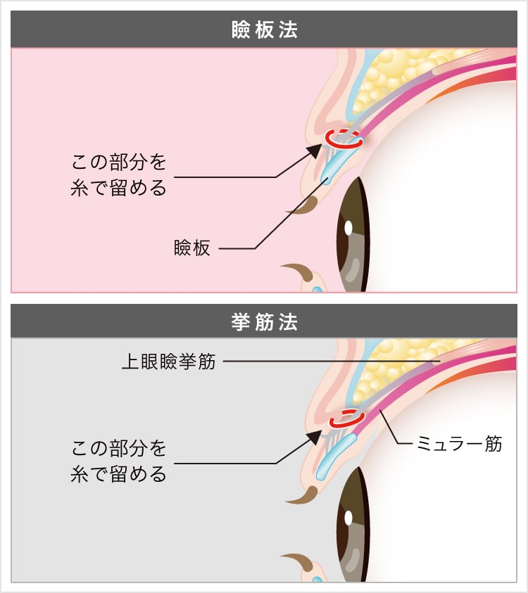 埋没法は目に悪くないの 術後の腫れや安全性 持続性について 美容整形なら東京中央美容外科 Tcb公式