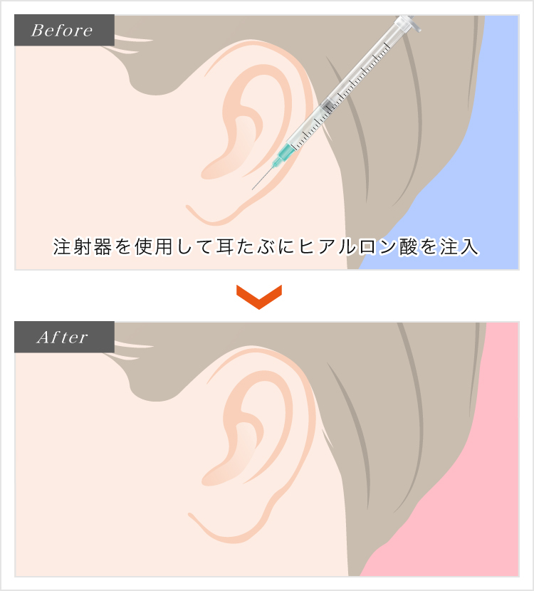 耳たぶのヒアルロン酸注射