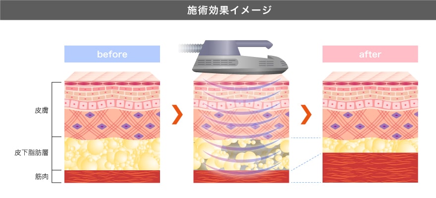 ダイエットスカルプト | 医療ダイエット（医療痩身） | 美容整形はTCB 