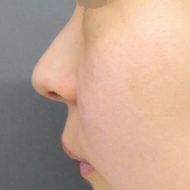 鼻のヒアルロン酸注射の症例写真01