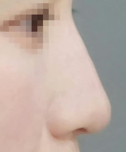 鼻のヒアルロン酸注射の症例写真04