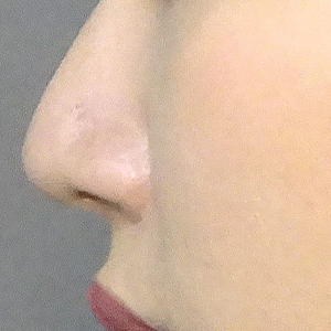 3D鼻尖形成（切らない鼻尖形成）症例写真01AFTER