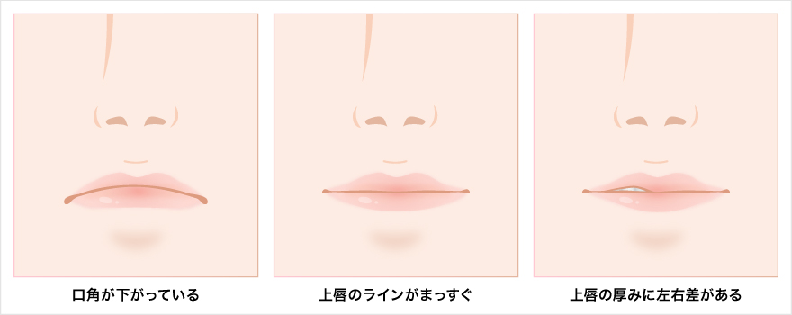M字リップ形成術に適した唇の種類