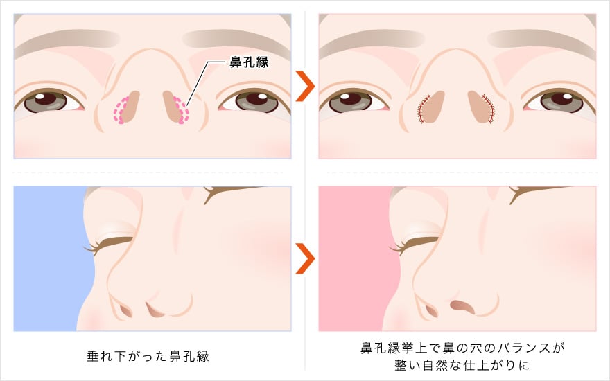 TCB東京中央美容外科 鼻孔縁挙上 施術の特徴