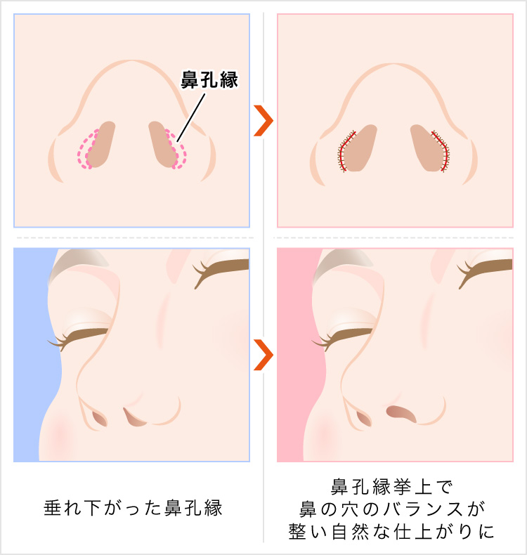 鼻孔縁挙上で鼻の穴のバランスが整う