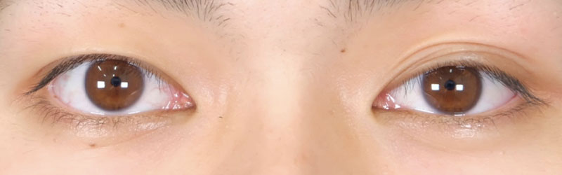 二重まぶた切開法 経過とダウンタイムも解説 美容整形なら東京中央美容外科 Tcb公式