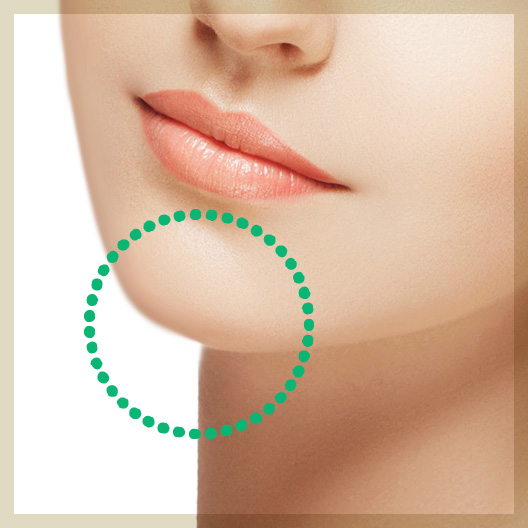 顎のボトックス注射（注入）